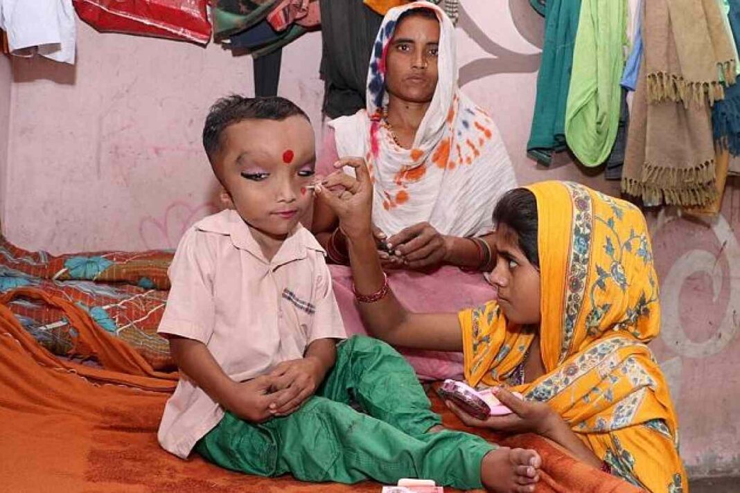 Indian boy with swollen head who cannot walk is worshipped as a HINDU GOD